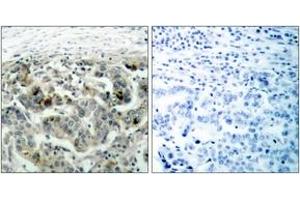 Immunohistochemistry analysis of paraffin-embedded human breast carcinoma tissue, using NF-kappaB p105/p50 (Ab-907) Antibody. (NFKB1 anticorps  (AA 874-923))
