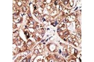 IHC analysis of FFPE human hepatocarcinoma tissue stained with the NeuroD1 antibody