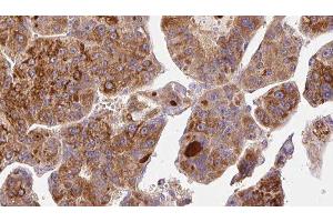 ABIN6277026 at 1/100 staining Human liver cancer tissue by IHC-P. (CD73 anticorps  (N-Term))