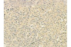 ABIN6260771 and ABIN6279279 at 1/100 staining human pituitary adenoma by IHC-P. (CEP72 anticorps  (Internal Region))