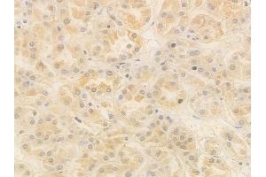 ABIN7095046 and ABIN7099102 at 1/100 staining human renal cell carcinoma by IHC-P. (FOXN3 anticorps)