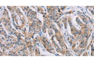Immunohistochemistry of paraffin-embedded Human prostate cancer tissue using ATP2C1 Polyclonal Antibody at dilution 1:50 (ATP2C1 anticorps)