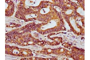 IHC image of ABIN7165641 diluted at 1:300 and staining in paraffin-embedded human colon cancer performed on a Leica BondTM system.