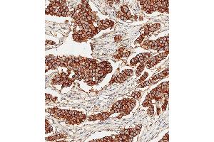 Immunohistochemical analysis of paraffin-embedded Human breast carcinoma tissue using E performed on the Leica® BOND RXm. (ErbB2/Her2 anticorps)