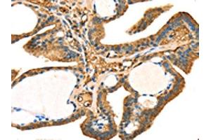 The image on the left is immunohistochemistry of paraffin-embedded Human thyroid cancer tissue using ABIN7131239(STX18 Antibody) at dilution 1/25, on the right is treated with fusion protein. (Syntaxin 18 anticorps)