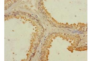 Immunohistochemistry of paraffin-embedded human prostate cancer using ABIN7167139 at dilution of 1:100