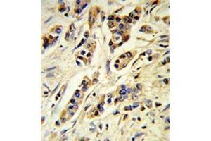 Human breast carcinoma (formalin-fixed, paraffin-embedded) reacted with IL10 Antibody , which was peroxidase-conjugated to the secondary antibody, followed by DAB staining. (IL-10 anticorps  (Middle Region))