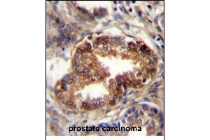 RAB3D Antibody (C-term) (ABIN657140 and ABIN2846278) immunohistochemistry analysis in formalin fixed and paraffin embedded human prostate carcinoma followed by peroxidase conjugation of the secondary antibody and DAB staining. (RAB3D anticorps  (C-Term))