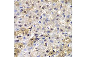 Immunohistochemistry of paraffin-embedded human liver cancer using MAD1L1 antibody.