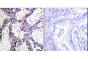 Immunohistochemistry analysis of paraffin-embedded human lung carcinoma, using MKP1 (Phospho-Ser359) Antibody. (DUSP1 anticorps  (pSer359))