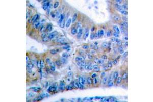Immunohistochemical analysis of BCLX (pS62) staining in human colon cancer formalin fixed paraffin embedded tissue section. (BCL2L1 anticorps  (pSer62))