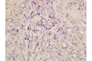 Formalin-fixed and paraffin embedded human lung carcinoma labeled with Rabbit Anti-EMR1 Polyclonal Antibody, Unconjugated  at 1:200 followed by conjugation to the secondary antibody and DAB staining