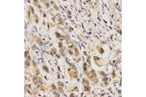 Immunohistochemistry of paraffin-embedded human stomach cancer using NFE2L2 antibody at dilution of 1:200 (x400 lens) (NRF2 anticorps  (AA 366-605))