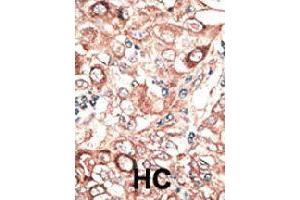 Formalin-fixed and paraffin-embedded human hepatocellular carcinoma tissue reacted with GJB2 polyclonal antibody  , which was peroxidase-conjugated to the secondary antibody, followed by DAB staining. (GJB2 anticorps  (C-Term))