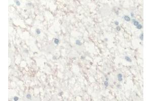 Detection of IL10 in Human Glioma Tissue using Monoclonal Antibody to Interleukin 10 (IL10)