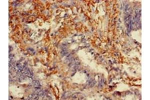 Immunohistochemistry of paraffin-embedded human colon cancer using ABIN7159304 at dilution of 1:100 (Melanophilin anticorps  (AA 310-539))