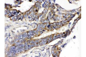 SLC2A5 was detected in paraffin-embedded sections of human intestinal cancer tissues using rabbit anti-SLC2A5 Antigen Affinity purified polyclonal antibody (Catalog # ) at 1 ?