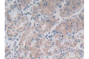 DAB staining on IHC-P; Samples: Human Breast cancer Tissue) (TLR1 anticorps  (AA 114-339))