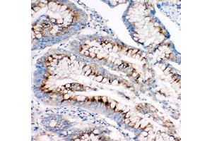 Anti-Mannose 6 Phosphate Receptor(Cation independent) antibody, IHC(P) IHC(P): Human Intestinal Cancer Tissue