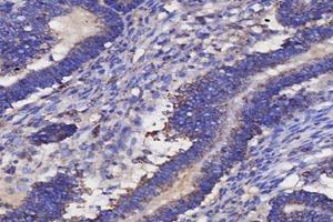 Immunohistochemistry analysis of paraffin-embedded human ovarian cancer using IL-3RB (ABIN7073557) at dilution of 1: 4000