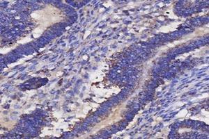 Immunohistochemistry analysis of paraffin-embedded human ovarian cancer using IL-3RB (ABIN7073557) at dilution of 1: 4000 (CD131 anticorps)