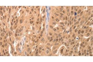 Immunohistochemistry of paraffin-embedded Human breast cancer tissue using JUND Polyclonal Antibody at dilution 1:60 (JunD anticorps)
