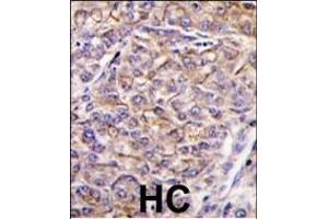 Formalin-fixed and paraffin-embedded human hepatocarcinoma tissue reacted with TAOK3 antibody (C-term) (ABIN390997 and ABIN2841175) , which was peroxidase-conjugated to the secondary antibody, followed by DAB staining. (TAO Kinase 3 anticorps  (C-Term))