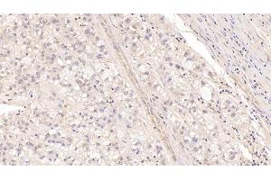 Detection of MBP in Human Liver cancer Tissue using Monoclonal Antibody to Major Basic Protein (MBP)