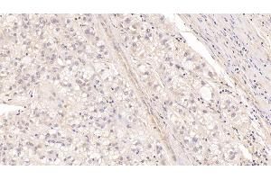 Detection of MBP in Human Liver cancer Tissue using Monoclonal Antibody to Major Basic Protein (MBP) (Major Basic Protein anticorps  (AA 105-222))