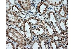 Immunohistochemical staining of paraffin-embedded Carcinoma of liver tissue using anti-LIPG mouse monoclonal antibody. (LIPG anticorps)