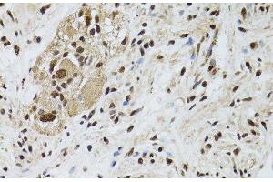 Immunohistochemistry of paraffin-embedded Human colon carcinoma using LKB1 Polyclonal Antibody at dilution of 1:100 (40x lens). (LKB1 anticorps)