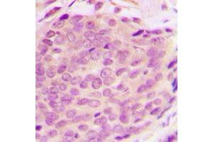 Immunohistochemical analysis of RNF125 staining in human breast cancer formalin fixed paraffin embedded tissue section.