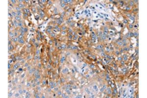 The image on the left is immunohistochemistry of paraffin-embedded Human lung cancer tissue using ABIN7130650(PLCZ1 Antibody) at dilution 1/25, on the right is treated with fusion protein. (PLCz1 anticorps)