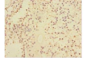 Immunohistochemistry of paraffin-embedded human breast cancer using ABIN7170630 at dilution of 1:100 (Splicing factor U2AF 26 kDa subunit (U2AF1L4) (AA 1-202) anticorps)
