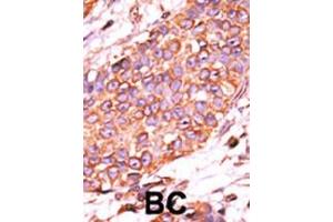 Formalin-fixed and paraffin-embedded human cancer tissue reacted with the primary antibody, which was peroxidase-conjugated to the secondary antibody, followed by AEC staining. (DUSP13-L184 (AA 169-198), (C-Term) anticorps)
