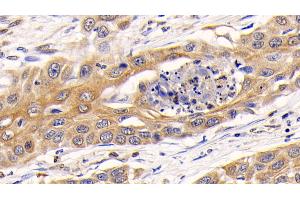 Detection of CTSK in Human Lung cancer Tissue using Polyclonal Antibody to Cathepsin K (CTSK)