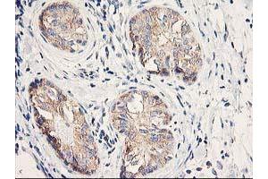 Immunohistochemical staining of paraffin-embedded Adenocarcinoma of Human breast tissue using anti-EIF2B3 mouse monoclonal antibody. (EIF2B3 anticorps)