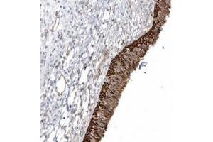 Immunohistochemical staining of human nasopharynx with DNAH1 polyclonal antibody  shows strong cytoplasmic and membranous positivity in respiratory epithelial cells at 1:200-1:500 dilution. (DNAH1 anticorps)