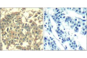 Immunohistochemical analysis of paraffin-embedded human breast carcinoma tissue using Met(Ab-1003) Antibody(left) or the same antibody preincubated with blocking peptide(right).