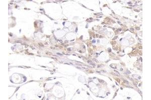 Detection of AR in Human Ovarian cancer Tissue using Polyclonal Antibody to Androgen Receptor (AR)