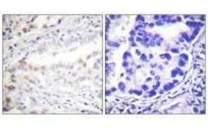 Immunohistochemistry analysis of paraffin-embedded human lung carcinoma tissue using Uba2 antibody. (UBA2 anticorps  (C-Term))
