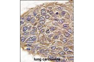 Formalin-fixed and paraffin-embedded human lung carcinoma tissue reacted with ALDOA antibody , which was peroxidase-conjugated to the secondary antibody, followed by DAB staining. (Aldolase anticorps  (N-Term))