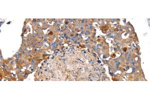 Immunohistochemistry of paraffin-embedded Human breast cancer tissue using IRS2 Polyclonal Antibody at dilution 1:100 (IRS2 anticorps)