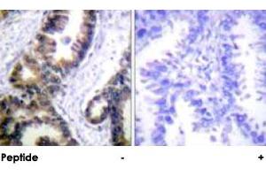Immunohistochemical analysis of paraffin-embedded human lung carcinoma tissue using DUSP1 polyclonal antibody . (DUSP1 anticorps)
