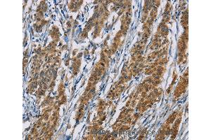 Immunohistochemistry of Human thyroid cancer using ACVR1 Polyclonal Antibody at dilution of 1:60