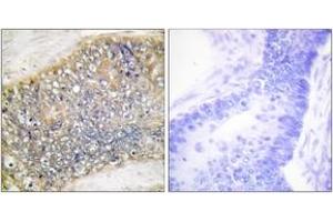 Immunohistochemistry analysis of paraffin-embedded human colon carcinoma tissue, using TALL-2 Antibody.