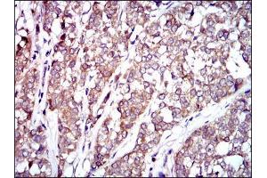Immunohistochemical analysis of paraffin-embedded bladder cancer tissues using RAF1 mouse mAb with DAB staining.