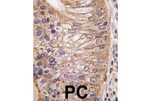 Formalin-fixed and paraffin-embedded human prostate carcinoma tissue reacted with PSCA polyclonal antibody  , which was peroxidase-conjugated to the secondary antibody, followed by DAB staining. (PSCA anticorps  (Internal Region))