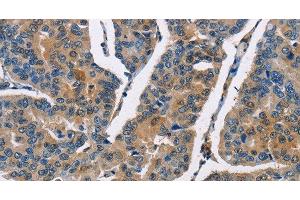 Immunohistochemistry of paraffin-embedded Human breast cancer using CBR1 Polyclonal Antibody at dilution of 1:40