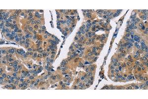 Immunohistochemistry of paraffin-embedded Human breast cancer using CBR1 Polyclonal Antibody at dilution of 1:40 (CBR1 anticorps)